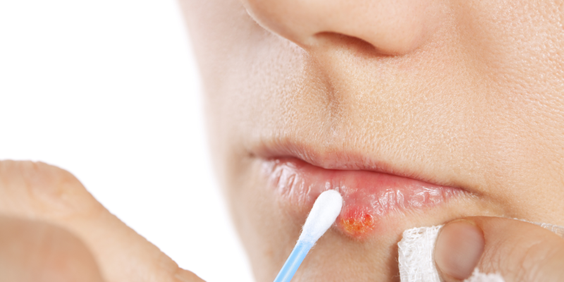 Herpes labial y alimentación
